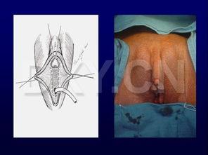 变性手术图片,从术前准备到术后康复